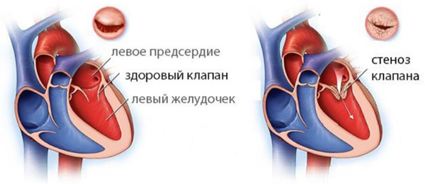 Болезни системы кровообращения