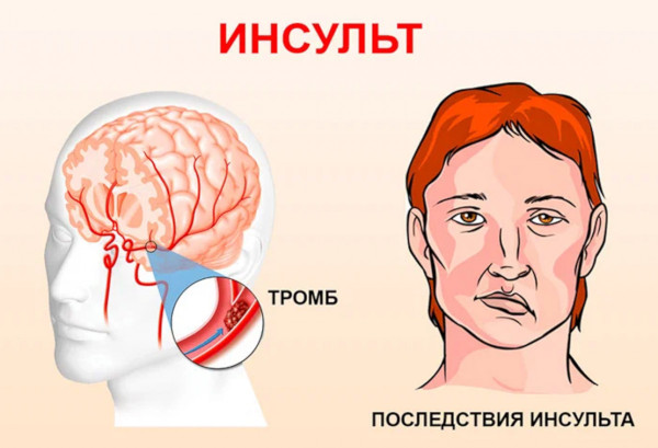 Болезни системы кровообращения