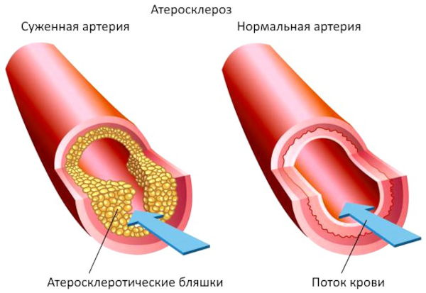 Болезни системы кровообращения