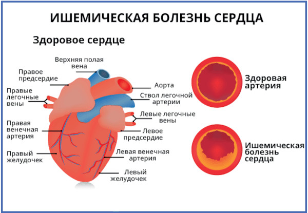 Болезни системы кровообращения