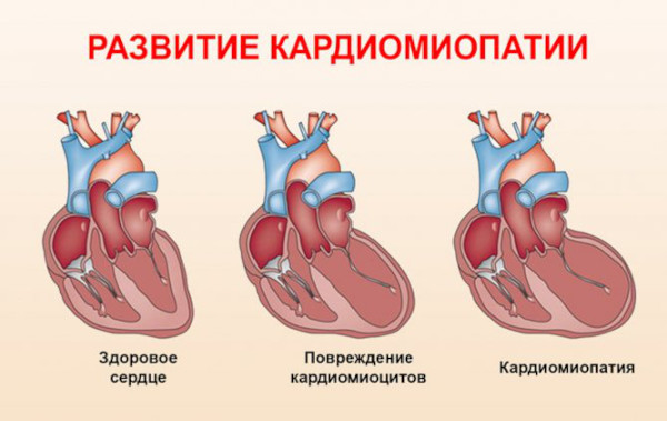 Болезни системы кровообращения