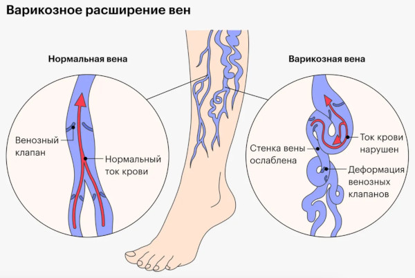 Болезни системы кровообращения