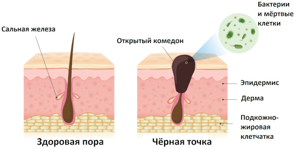 Черные точки в ушах. Как избавиться, убрать