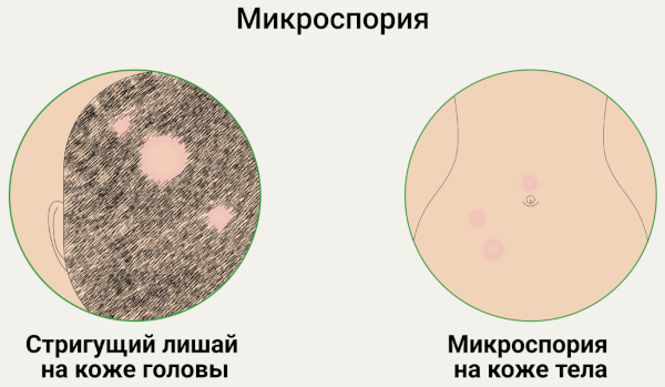 Грибок кожи головы. Симптомы и лечение, фото