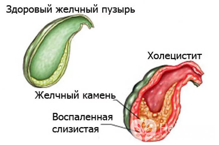 Холецистит при беременности 1-2-3 триместр. Симптомы и лечение