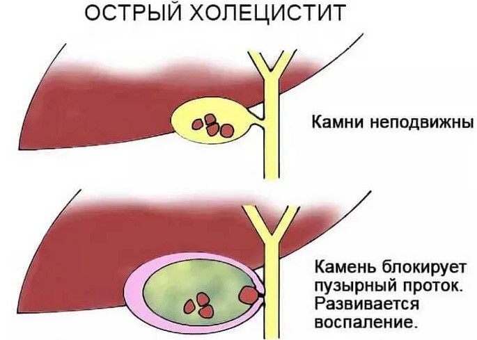 Холецистит при беременности 1-2-3 триместр. Симптомы и лечение