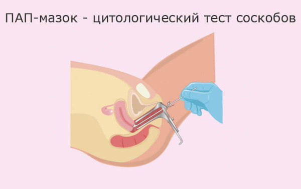 Конизация шейки матки. Что такое в гинекологии