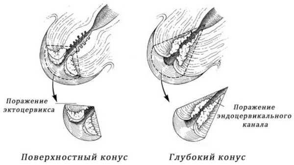 Конизация шейки матки. Что такое в гинекологии