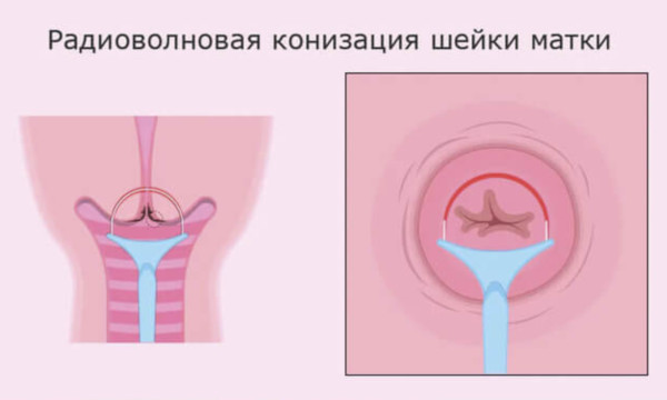 Конизация шейки матки. Что такое в гинекологии