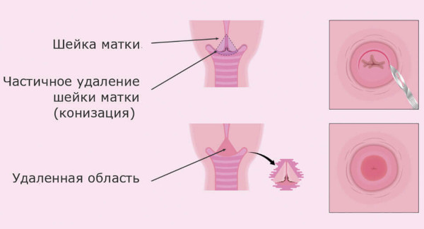 Конизация шейки матки. Что такое в гинекологии