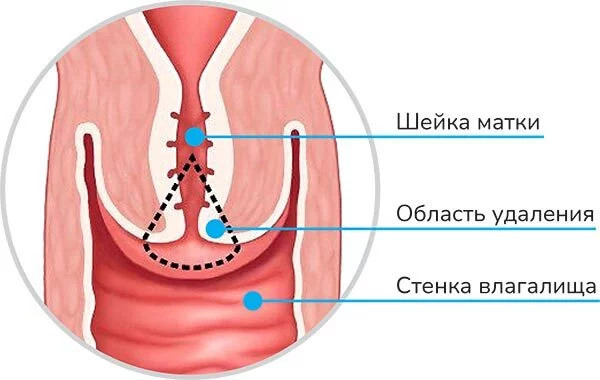 Конизация шейки матки. Что такое в гинекологии