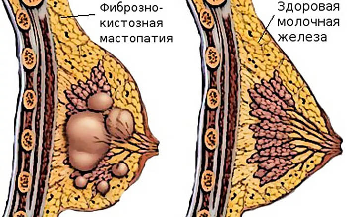 Мази при мастопатии молочной железы у женщин