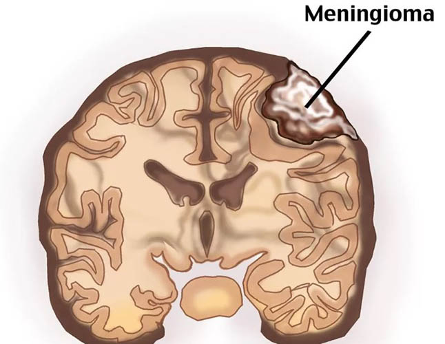Менингиома головного мозга. Лечение без операции