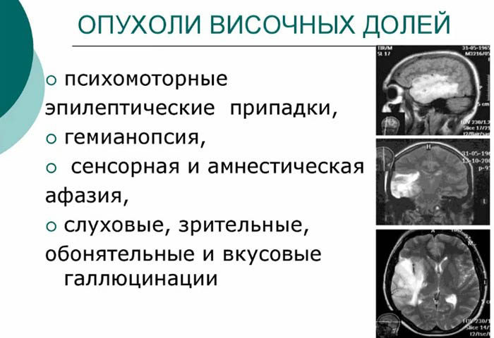 Менингиома головного мозга. Лечение без операции