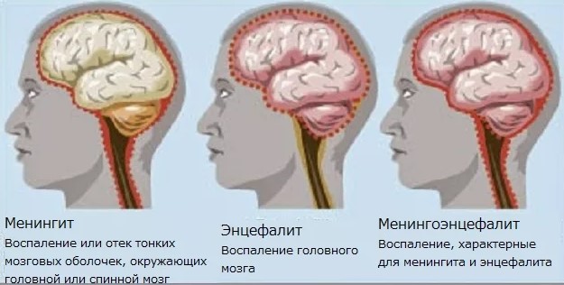 Менингоэнцефалит у детей. Что это, протекание болезни, симптомы