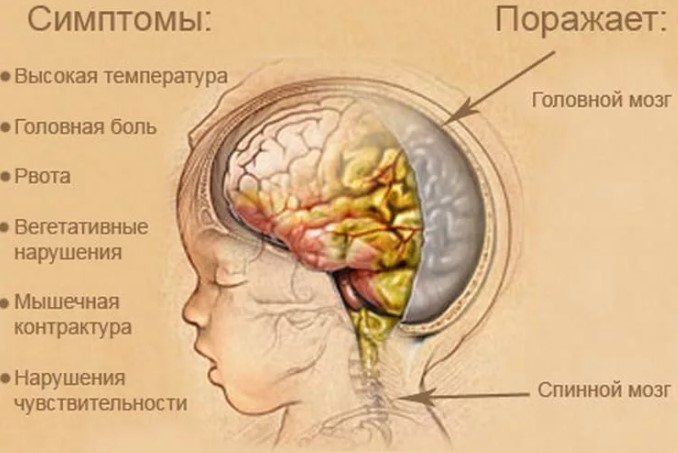 Менингоэнцефалит у детей. Что это, протекание болезни, симптомы