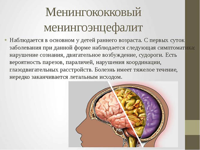 Менингоэнцефалит у детей. Что это, протекание болезни, симптомы