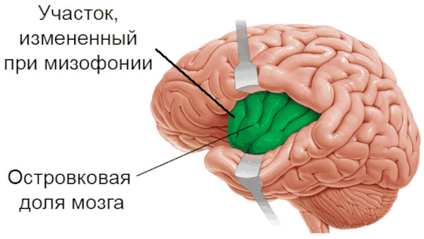 Мисофония это что за психическое заболевание, фобия