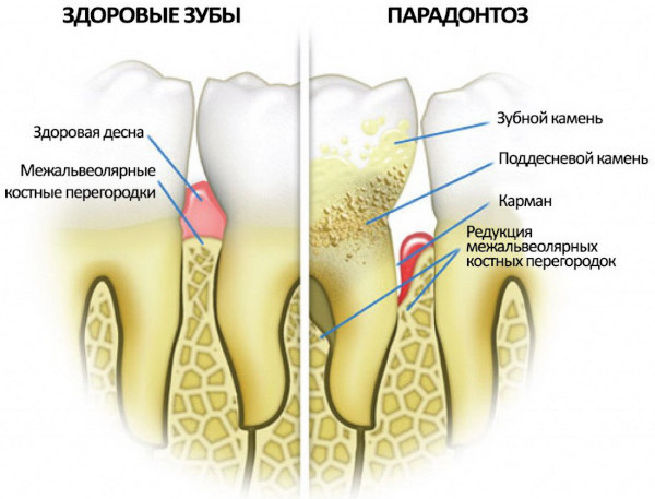 Облепиховое масло для десен и зубов. Инструкция