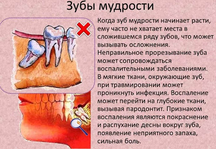 Опухла, воспалилась десна около зуба мудрости. Что делать