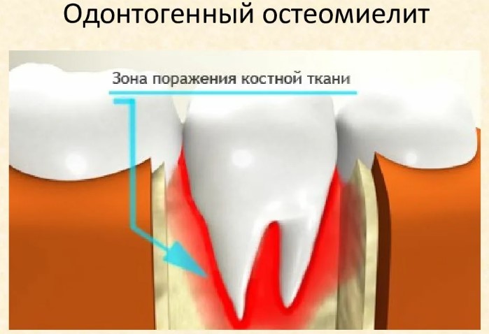 Опухла, воспалилась десна около зуба мудрости. Что делать