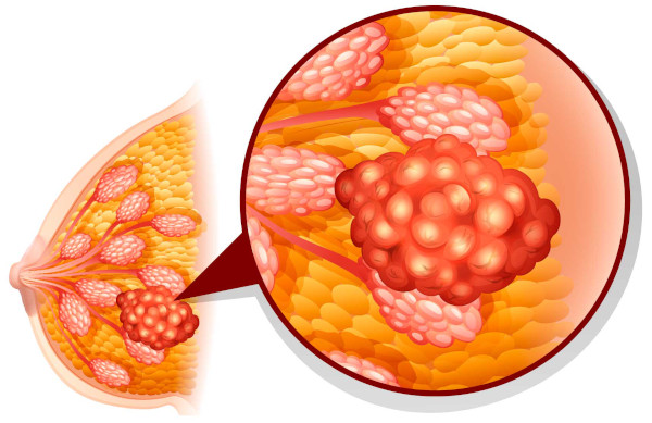 Опухоль молочной железы у женщин. Симптомы, признаки, лечение