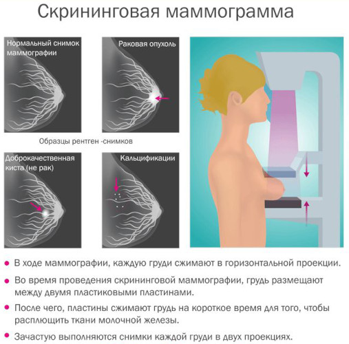 Опухоль молочной железы у женщин. Симптомы, признаки, лечение