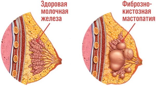 Опухоль молочной железы у женщин. Симптомы, признаки, лечение