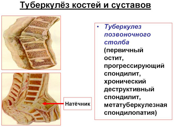 Осложнения, обострение после остеопата. Почему стало хуже, болит спина