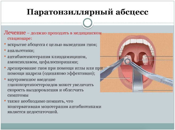 Паратонзиллярный абсцесс фотографии