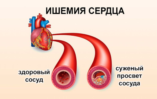 Пароксизмальная наджелудочковая тахикардия. Что это, лечение, препараты