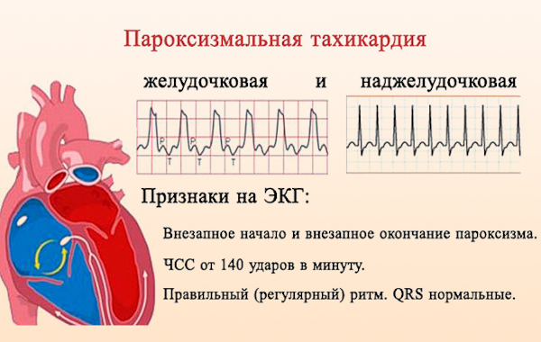 Пароксизмальная наджелудочковая тахикардия. Что это, лечение, препараты