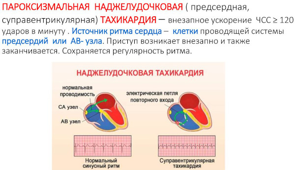 Пароксизмальная наджелудочковая тахикардия. Что это, лечение, препараты