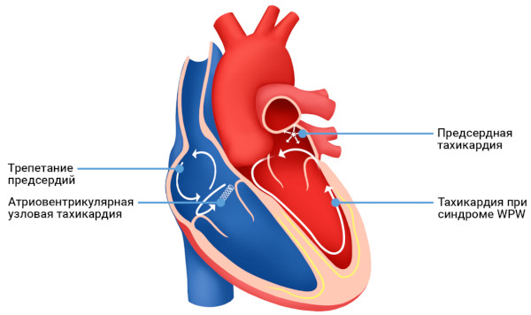 Пароксизмальная наджелудочковая тахикардия. Что это, лечение, препараты