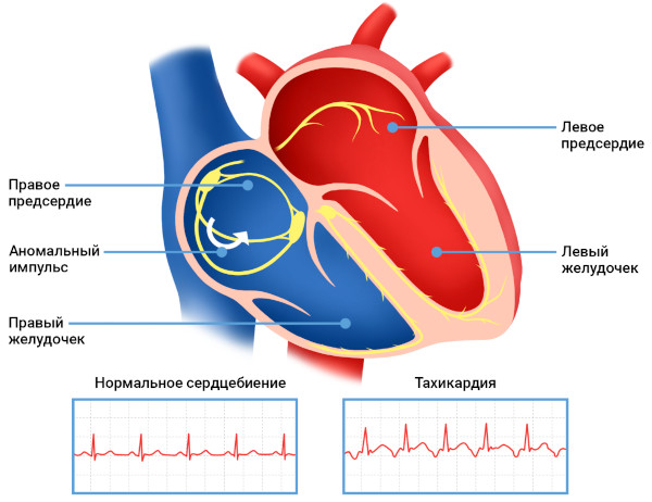 Пароксизмальная наджелудочковая тахикардия. Что это, лечение, препараты