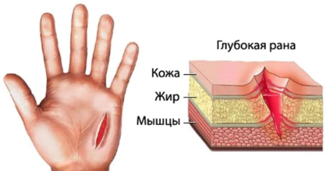 Порез пальца глубокий. Как лечить, что делать