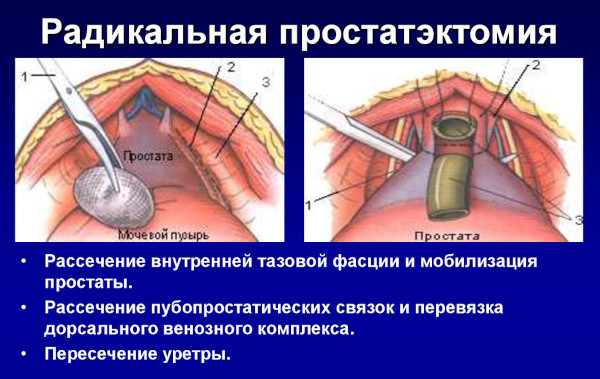 Простатэктомия радикальная. Реабилитация, последствия, отзывы