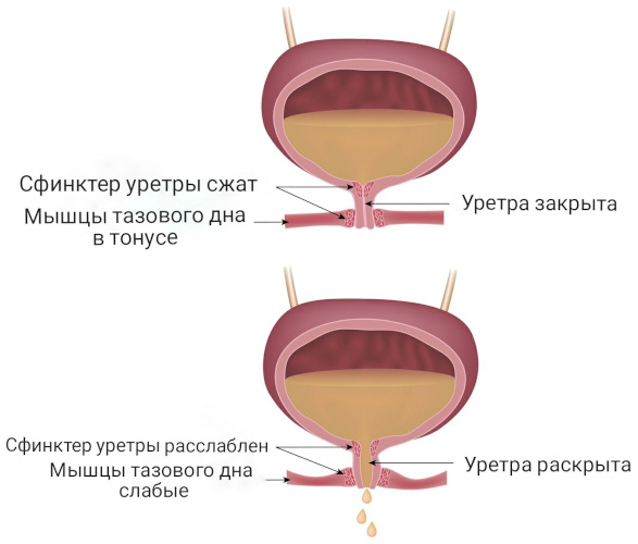 Простатэктомия радикальная. Реабилитация, последствия, отзывы