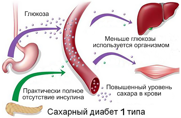 Простатэктомия радикальная. Реабилитация, последствия, отзывы