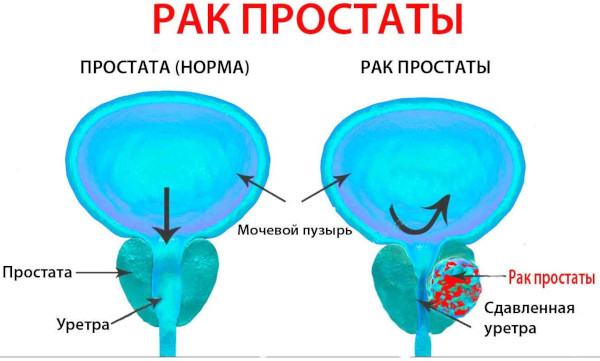 Тестостерон пропионат (Testosterone propionate). Инструкция по применению