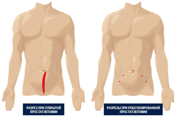 Простатэктомия радикальная. Реабилитация, последствия, отзывы