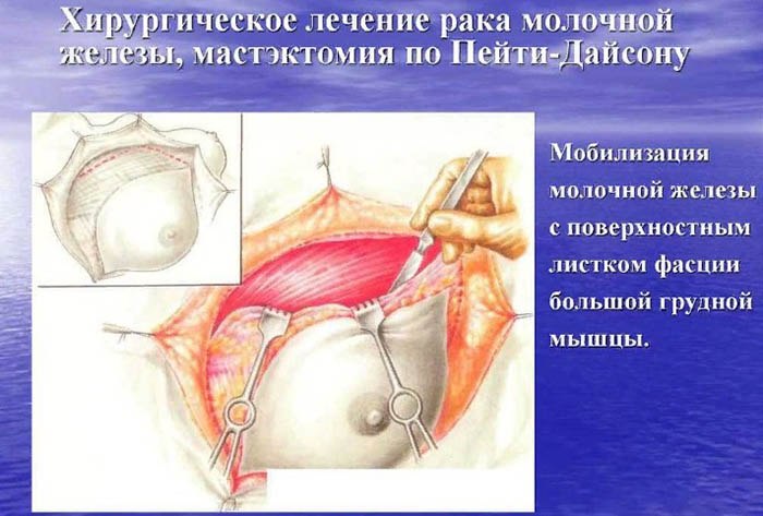 Радикальная резекция молочной железы. Что это такое, что значит