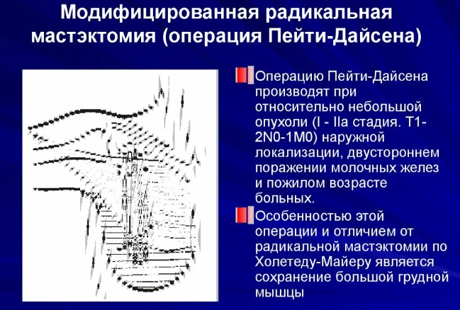 Радикальная резекция молочной железы. Что это такое, что значит