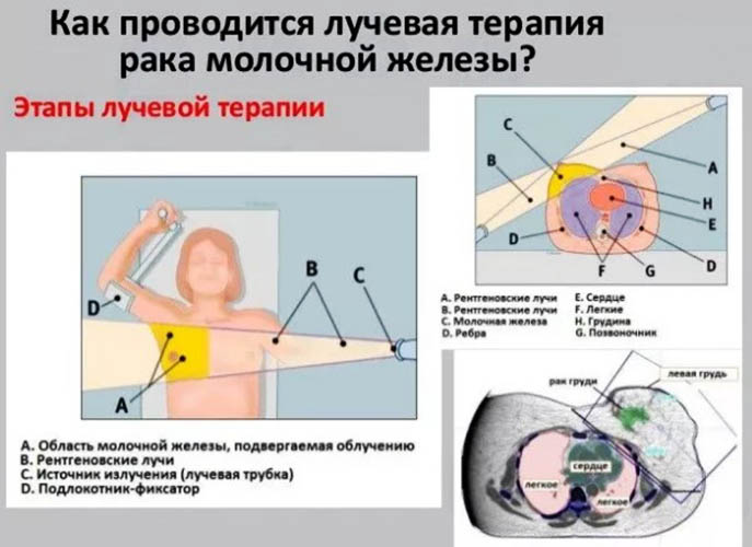 Радикальная резекция молочной железы. Что это такое, что значит