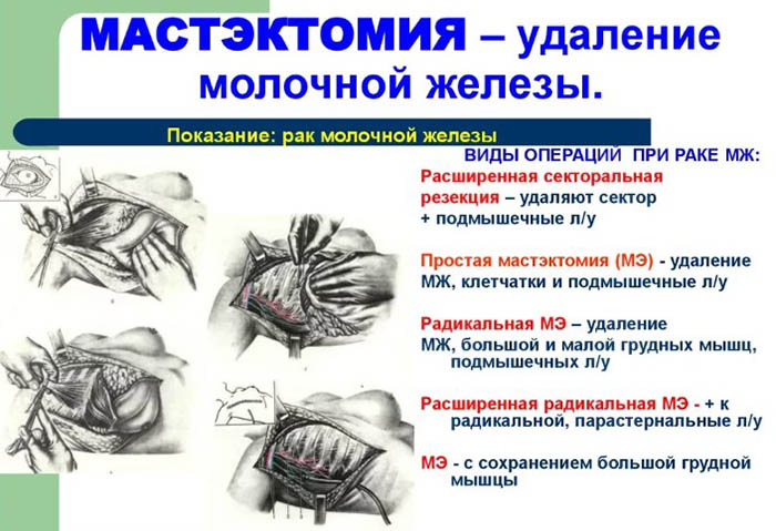 Радикальная резекция молочной железы. Что это такое, что значит