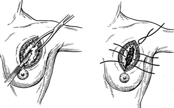 Секторальная резекция молочной железы фото