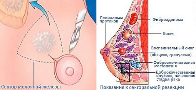 Секторальная резекция молочной железы. Что это такое, восстановление