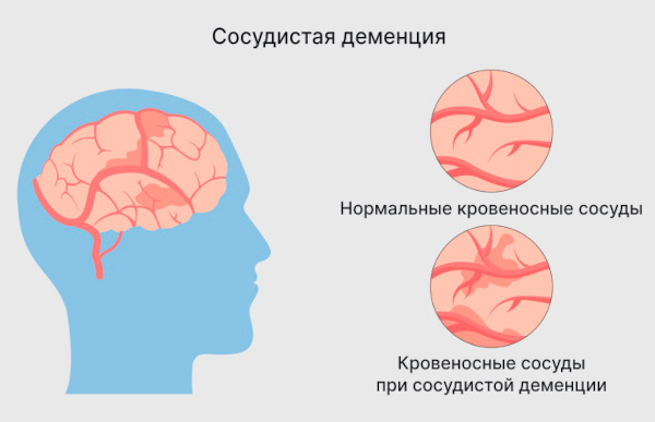 Сосудистая деменция. Симптомы, лечение у пожилых