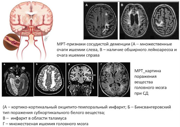 Сосудистая деменция. Симптомы, лечение у пожилых