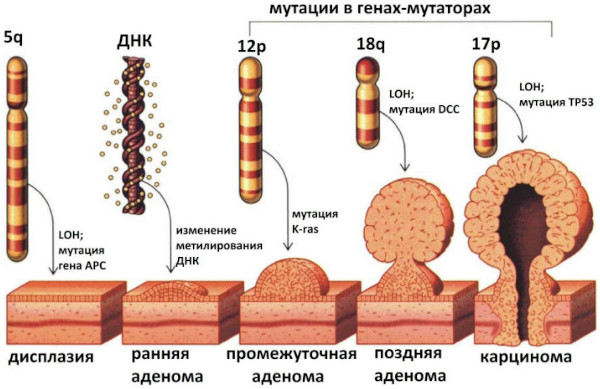 Тубулярная аденома толстой кишки с дисплазией low grade